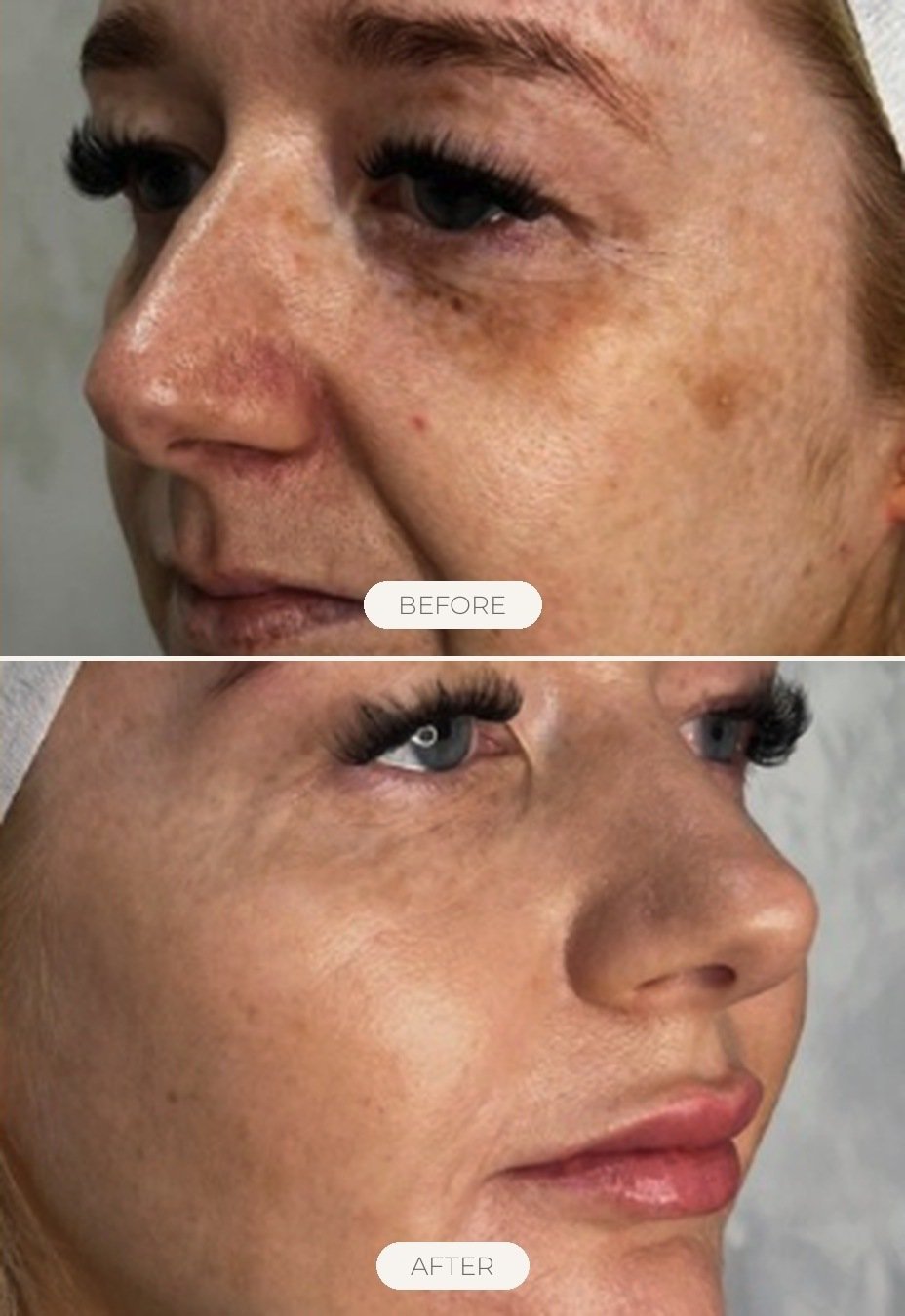 Medical Facials before and after