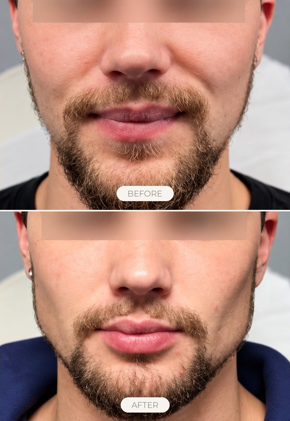 Dermal Fillers for men before and after