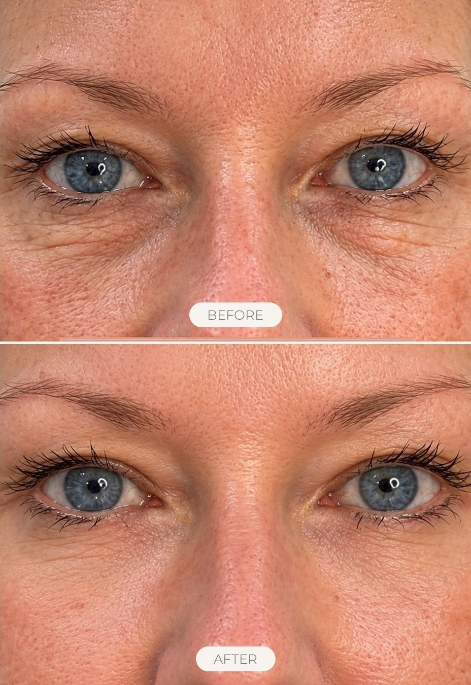Eye Rejuvenation before and after