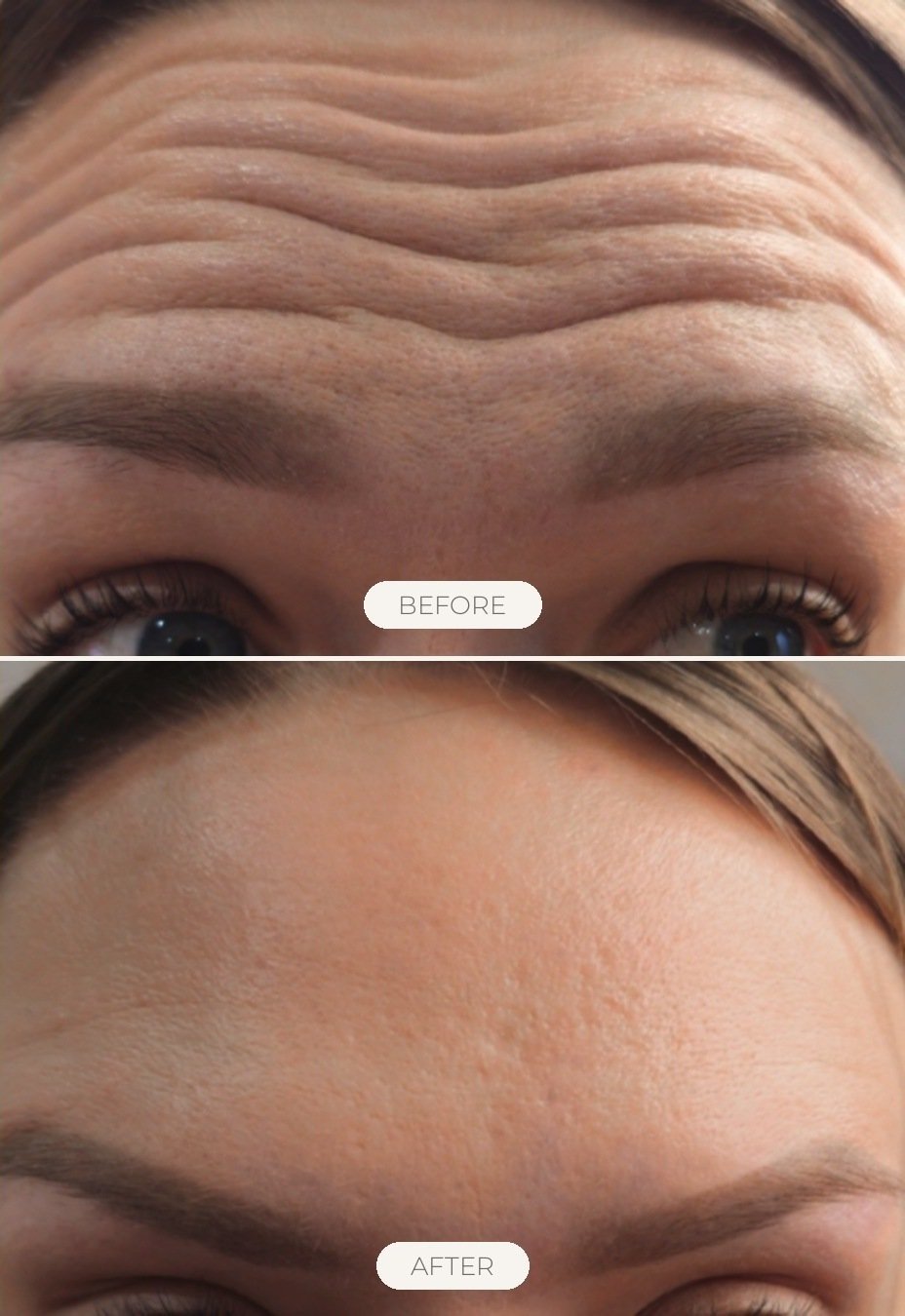 Anti-Wrinkle Injections before and after